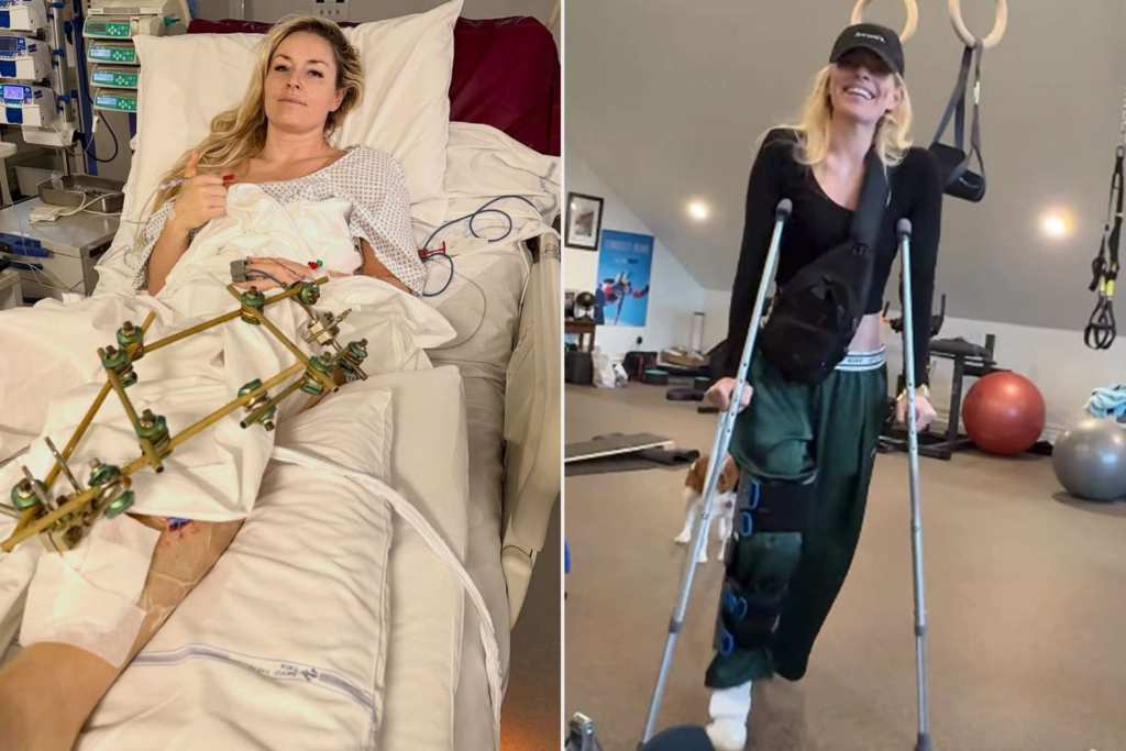 Understanding the Lindsey Vonn Injury: Challenges and Triumphs lindsey vonn injury