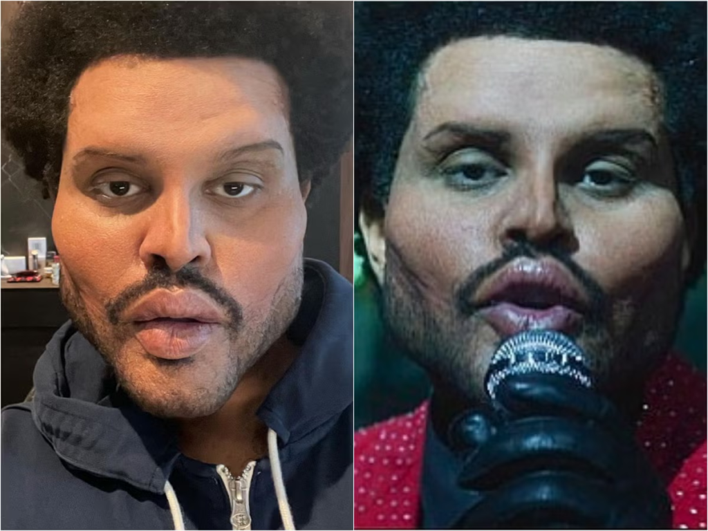 The Weeknd Surgery: A Deep Dive into the Star’s Transformation the weeknd surgery